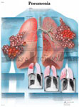 Pneumonia - Anatomical Chart